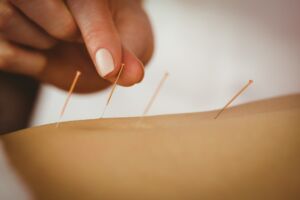 Young woman getting acupuncture treatment in therapy room